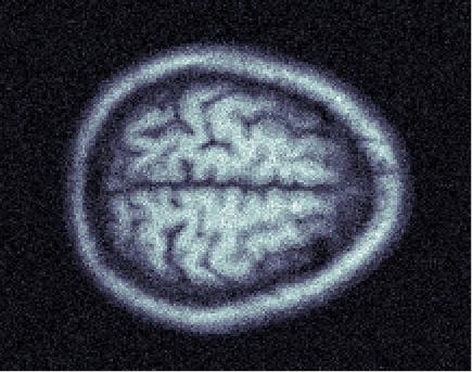 reference, T1 weighted MR image 